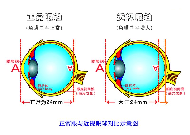 近視是怎樣形成的？視普泰驗(yàn)光師培訓(xùn)學(xué)院帶您走進(jìn)了解