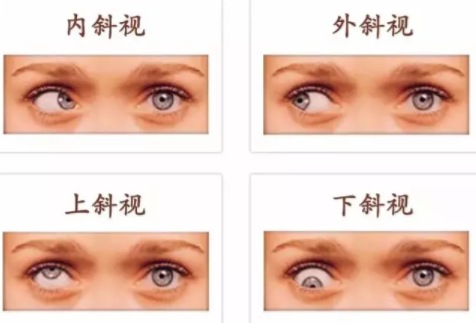 斜視和弱視可以永久治愈嗎？