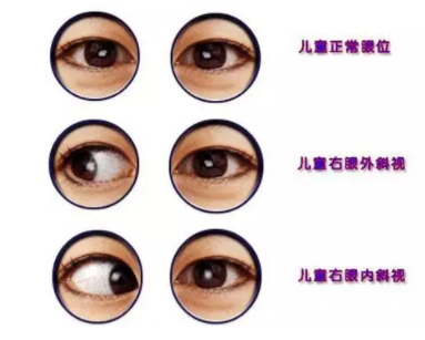 驗(yàn)光師培訓(xùn)測(cè)試斜視的一些小方法