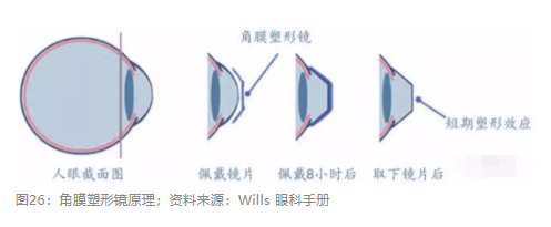 2018眼科行業(yè)報(bào)告：市場(chǎng)有較大增長(zhǎng)，消費(fèi)升級(jí)推動(dòng)角塑快速成長(zhǎng)