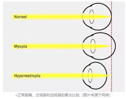 探討青少年近視與電子屏幕關(guān)系，近視關(guān)聯(lián)強(qiáng)因素詳細(xì)分析