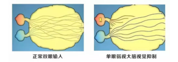 眼視光科普成人的弱斜視會影響正常生活嗎？