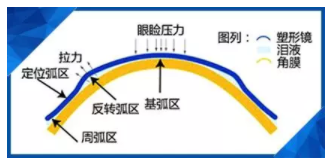 驗光師講述孩子戴了角膜塑形鏡近視度數(shù)還會漲嗎？