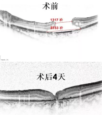 11歲患兒因激光筆損害視網(wǎng)膜造成罕見巨大黃斑裂孔，溫醫(yī)大眼視光成功治愈